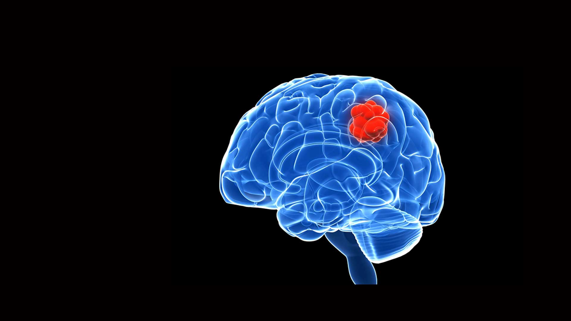 Brain tumour
